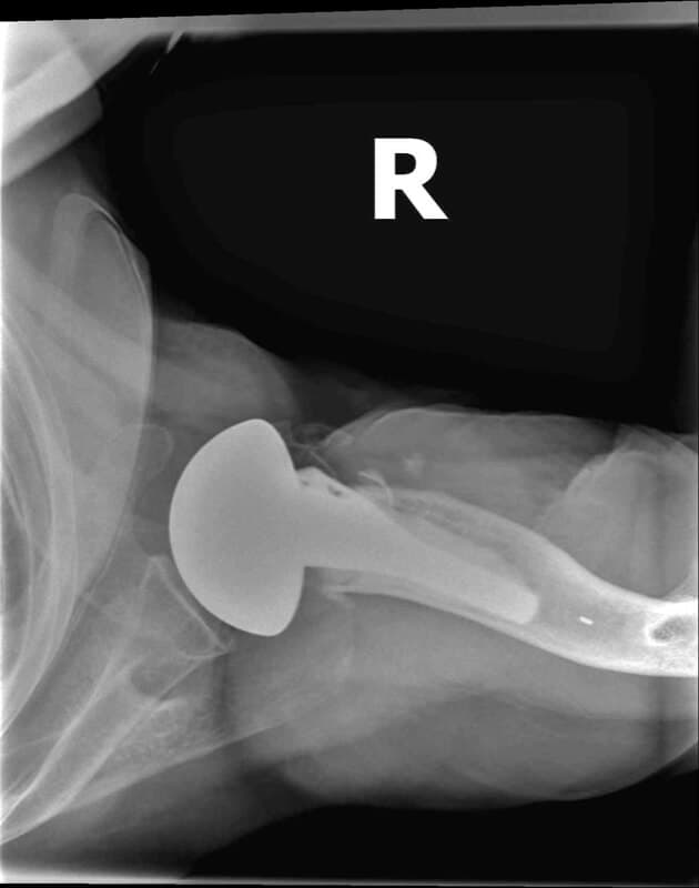 Stryker/Wright/Tornier - Standard - Anatomic<br><span>Click image to see a larger version.</span>