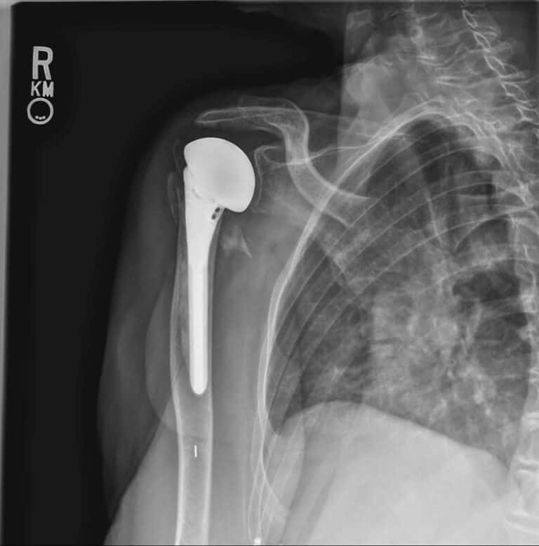 Stryker/Wright/Tornier - Standard - Anatomic<br><span>Click image to see a larger version.</span>