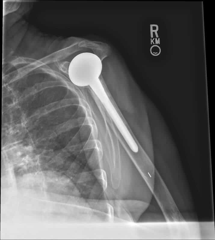 Stryker/Wright/Tornier - Standard - Anatomic<br><span>Click image to see a larger version.</span>