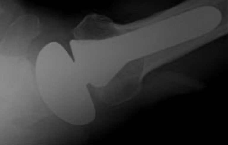 Stryker/Wright/Tornier - Standard - Anatomic<br><span>Click image to see a larger version.</span>