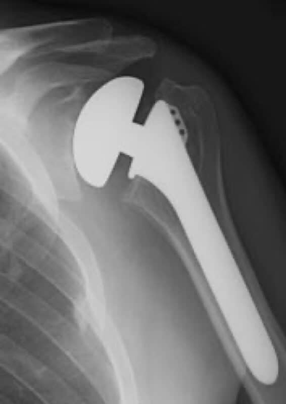 Stryker/Wright/Tornier - Standard - Anatomic<br><span>Click image to see a larger version.</span>