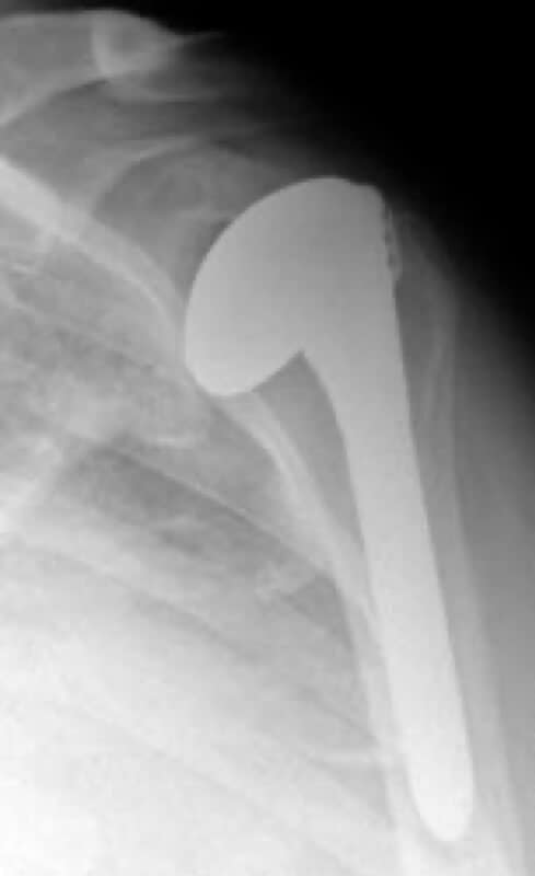 Stryker/Wright/Tornier - Standard - Anatomic<br><span>Click image to see a larger version.</span>