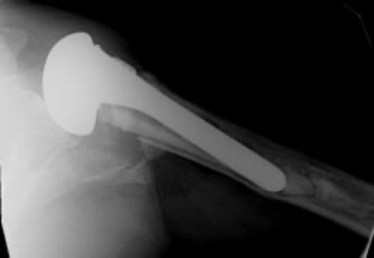 Stryker/Wright/Tornier - Standard - Anatomic<br><span>Click image to see a larger version.</span>