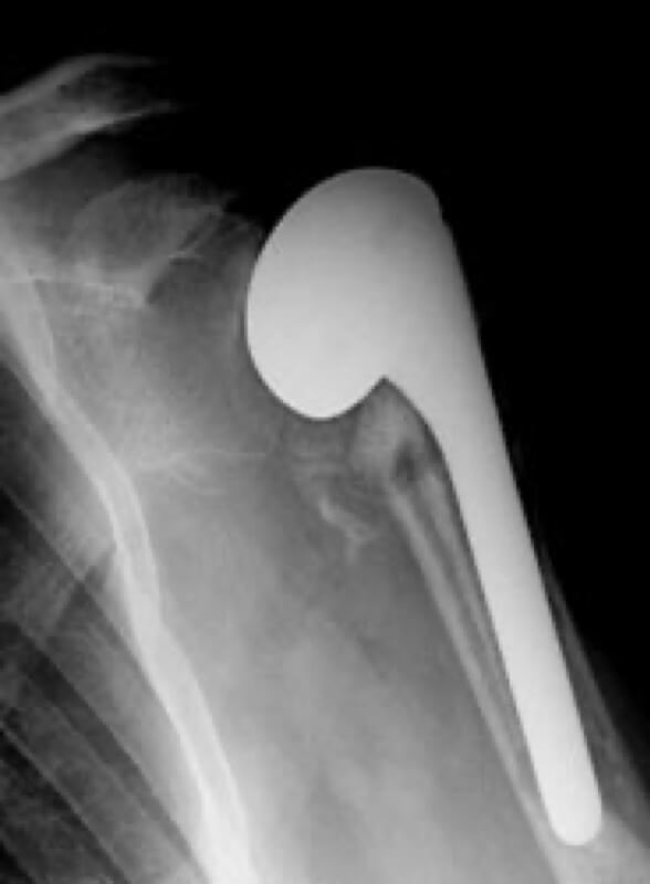 Stryker/Wright/Tornier - Standard - Anatomic<br><span>Click image to see a larger version.</span>