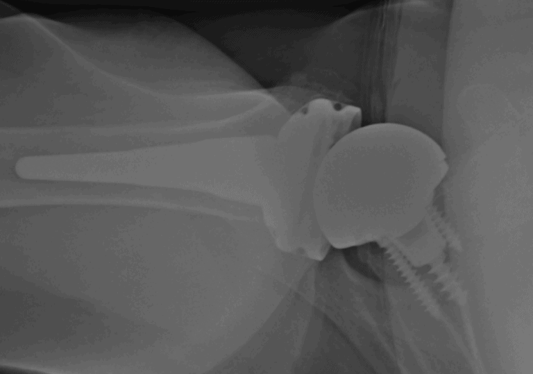 Arthrex - Glenoid - Reverse<br><span>Click image to see a larger version.</span>