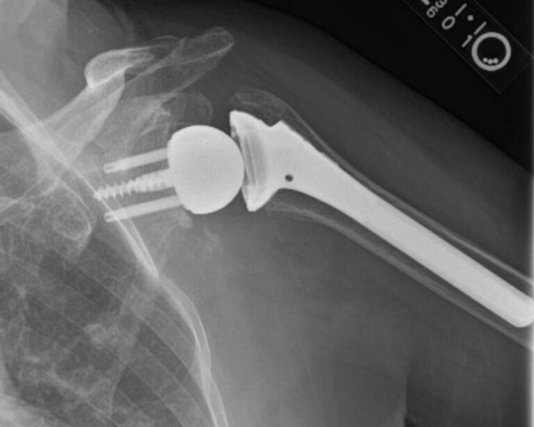 DJO/Enovis - Glenoid - Reverse<br><span>Click image to see a larger version.</span>