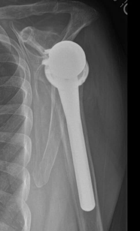 DJO/Enovis - Glenoid - Reverse<br><span>Click image to see a larger version.</span>