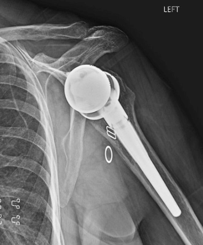 Lima - Glenoid - Reverse<br><span>Click image to see a larger version.</span>