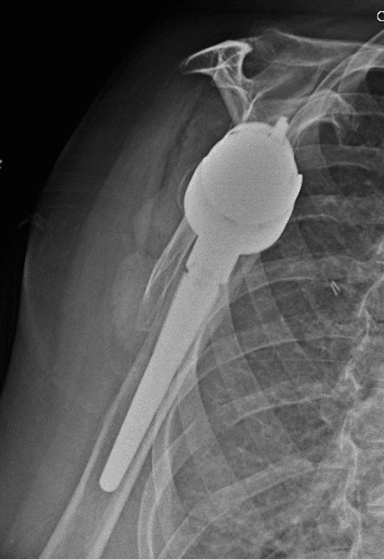 Lima - Glenoid - Reverse<br><span>Click image to see a larger version.</span>