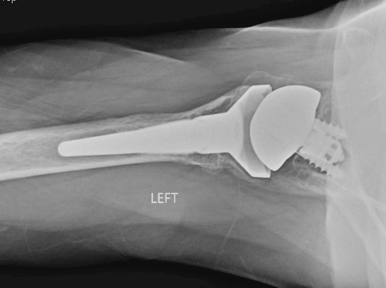 Lima - Glenoid - Reverse<br><span>Click image to see a larger version.</span>