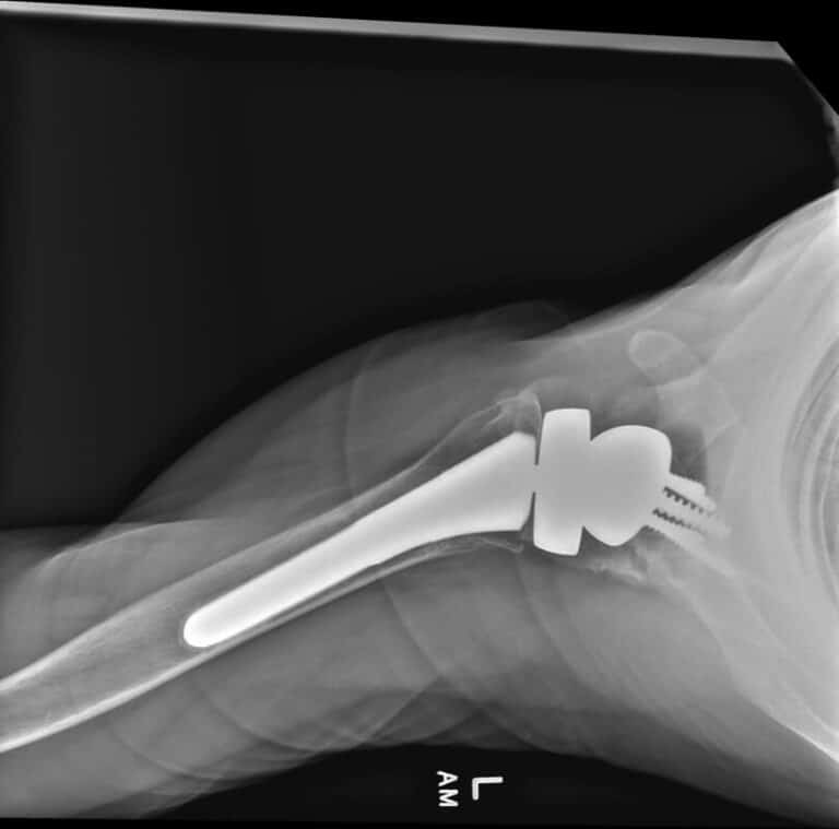 Stryker/Wright/Tornier - Glenoid - Reverse<br><span>Click image to see a larger version.</span>