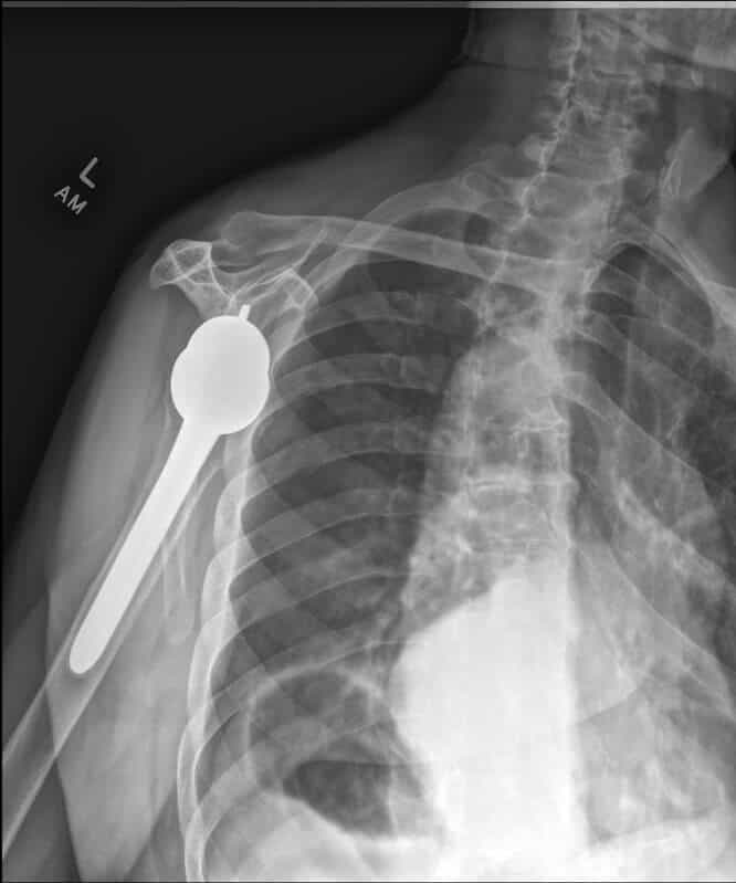 Stryker/Wright/Tornier - Glenoid - Reverse<br><span>Click image to see a larger version.</span>