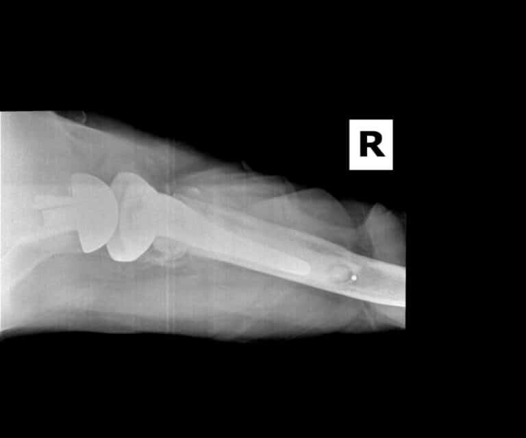 Stryker/Wright/Tornier - Glenoid - Reverse<br><span>Click image to see a larger version.</span>