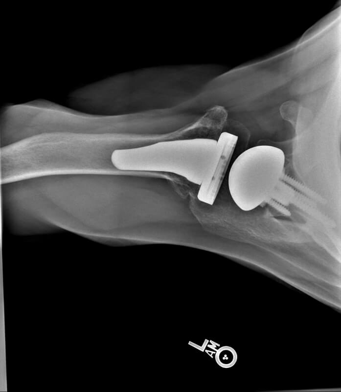 Stryker/Wright/Tornier - Glenoid - Reverse<br><span>Click image to see a larger version.</span>