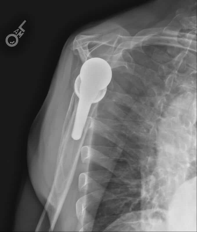 Stryker/Wright/Tornier - Glenoid - Reverse<br><span>Click image to see a larger version.</span>