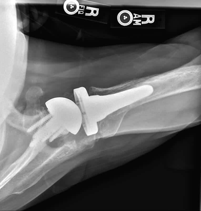 Stryker/Wright/Tornier - Glenoid - Reverse<br><span>Click image to see a larger version.</span>