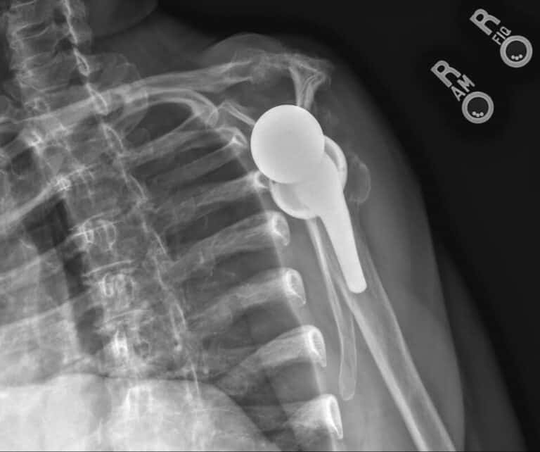 Stryker/Wright/Tornier - Glenoid - Reverse<br><span>Click image to see a larger version.</span>