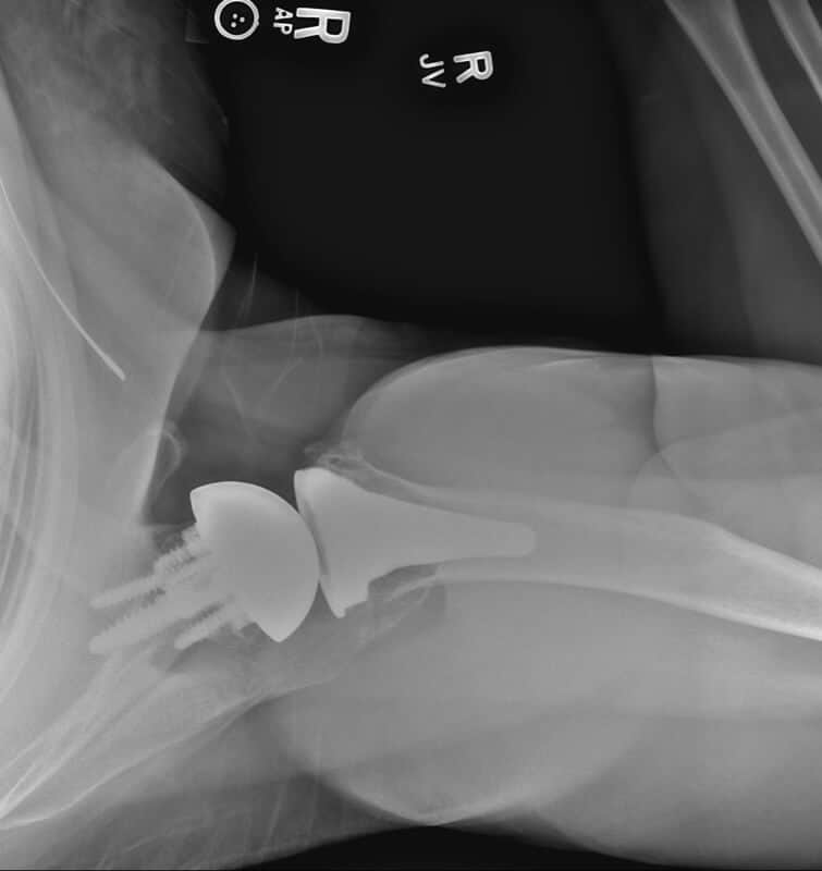 Stryker/Wright/Tornier - Glenoid - Reverse<br><span>Click image to see a larger version.</span>