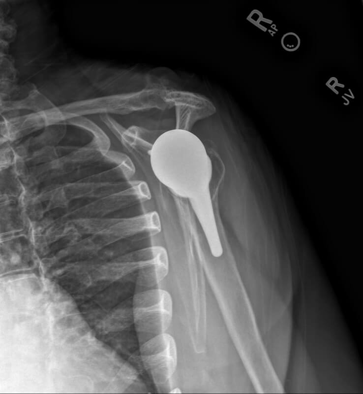 Stryker/Wright/Tornier - Glenoid - Reverse<br><span>Click image to see a larger version.</span>