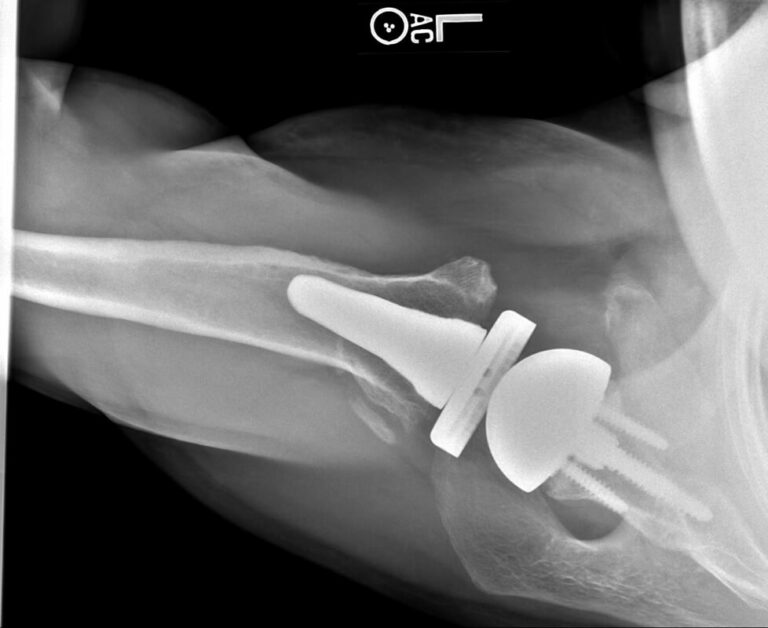 Stryker/Wright/Tornier - Glenoid - Reverse<br><span>Click image to see a larger version.</span>
