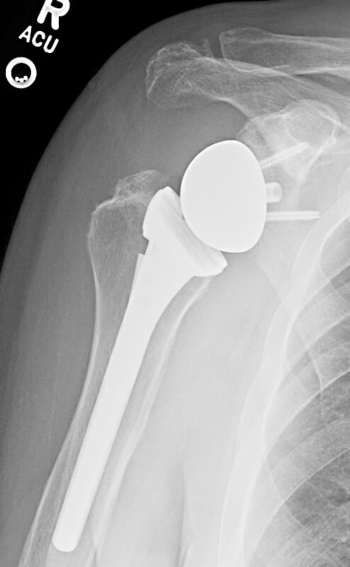 DePuy - Standard - Reverse<br><span>Click image to see a larger version.</span>