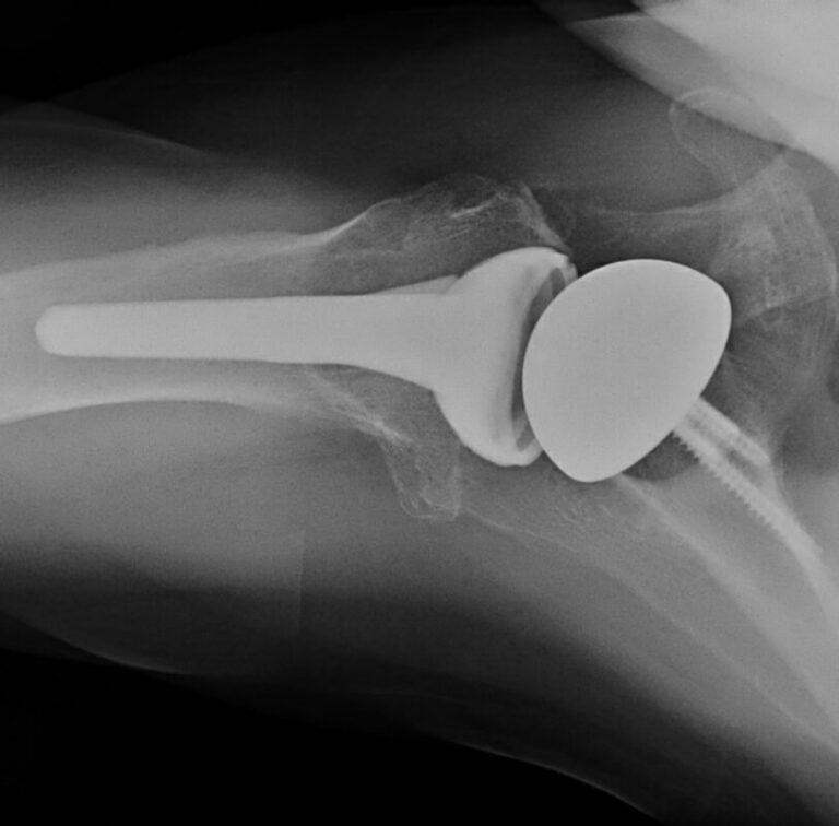 DePuy - Standard - Reverse<br><span>Click image to see a larger version.</span>