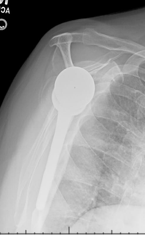 DePuy - Standard - Reverse<br><span>Click image to see a larger version.</span>