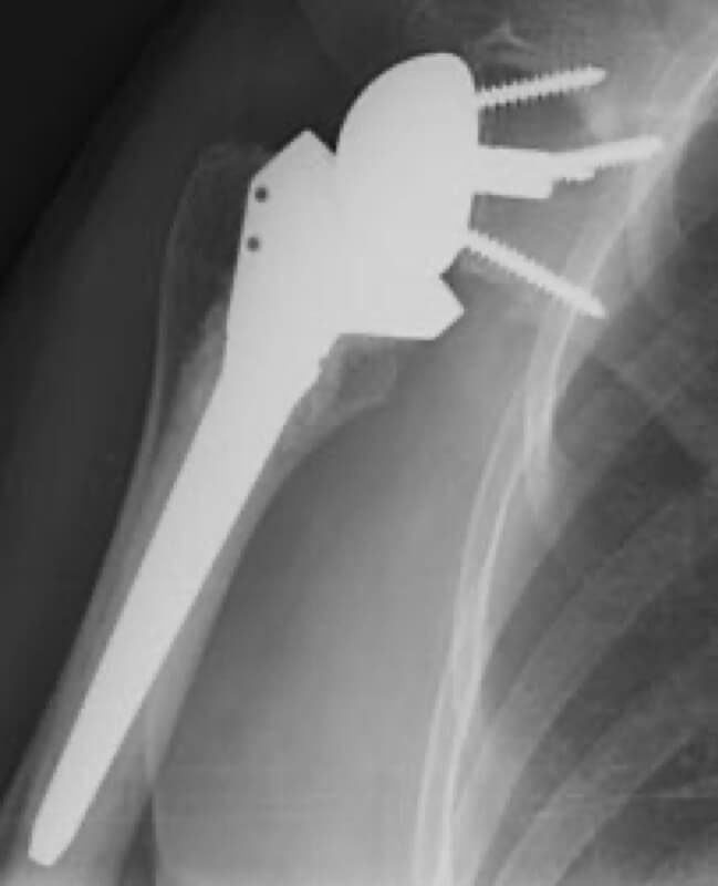 DePuy - Standard - Reverse<br><span>Click image to see a larger version.</span>