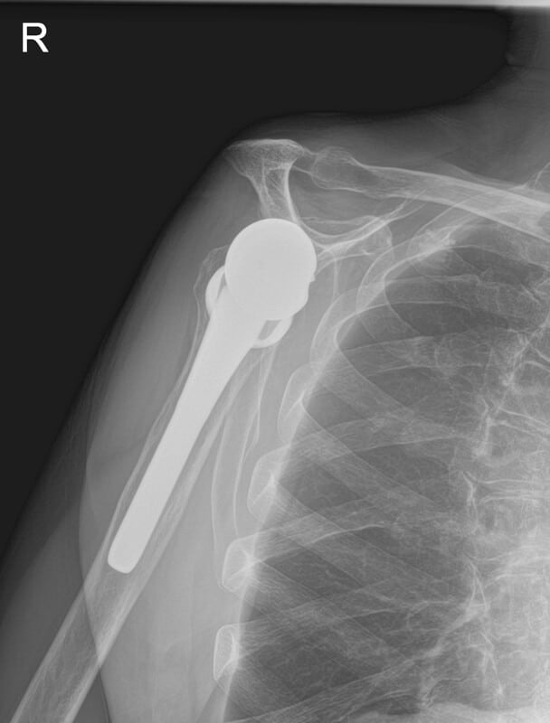 Exactech - Standard - Reverse<br><span>Click image to see a larger version.</span>