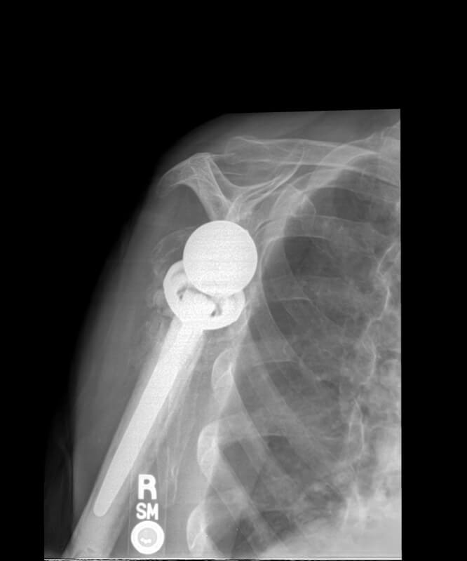 Stryker/Wright/Tornier - Standard - Reverse<br><span>Click image to see a larger version.</span>