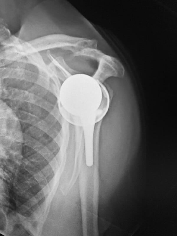 Shoulder Innovations - Short - Reverse<br><span>Click image to see a larger version.</span>