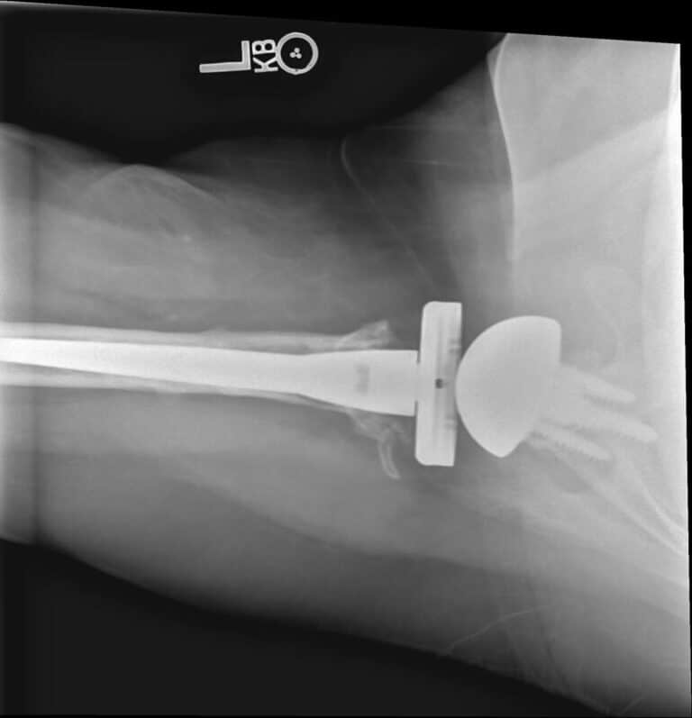 Stryker/Wright/Tornier - Long - Reverse<br><span>Click image to see a larger version.</span>