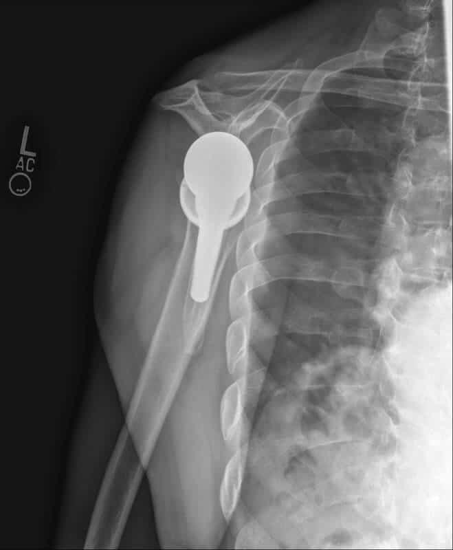 Stryker/Wright/Tornier - Short - Reverse<br><span>Click image to see a larger version.</span>