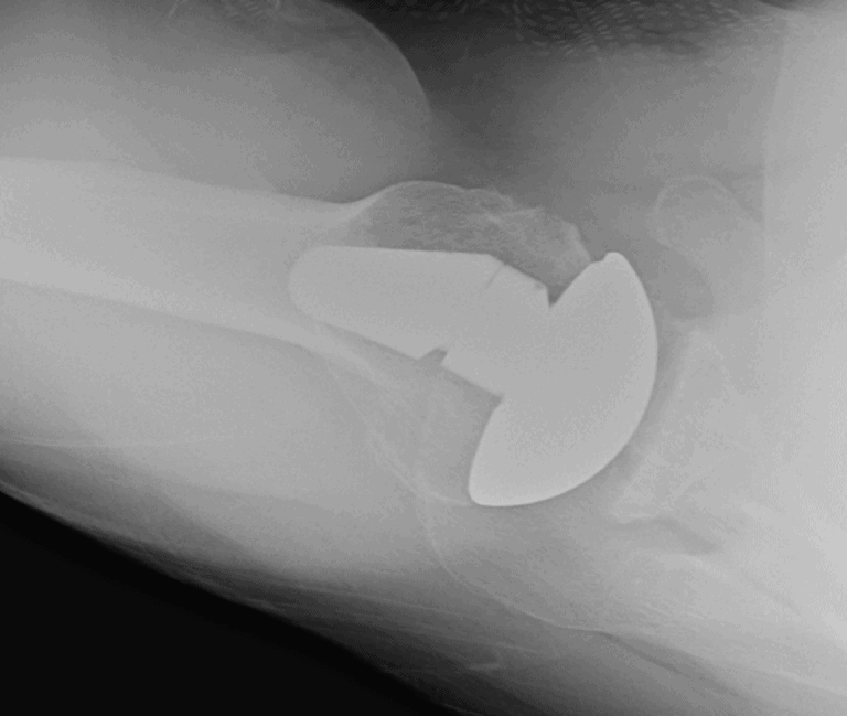 Arthrex - Short - Anatomic<br><span>Click image to see a larger version.</span>