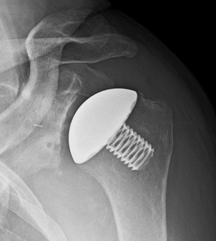 Arthrex - Stemless - Anatomic<br><span>Click image to see a larger version.</span>