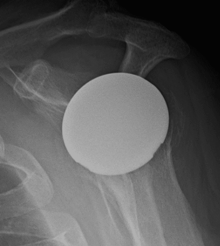 Arthrex - Stemless - Anatomic<br><span>Click image to see a larger version.</span>