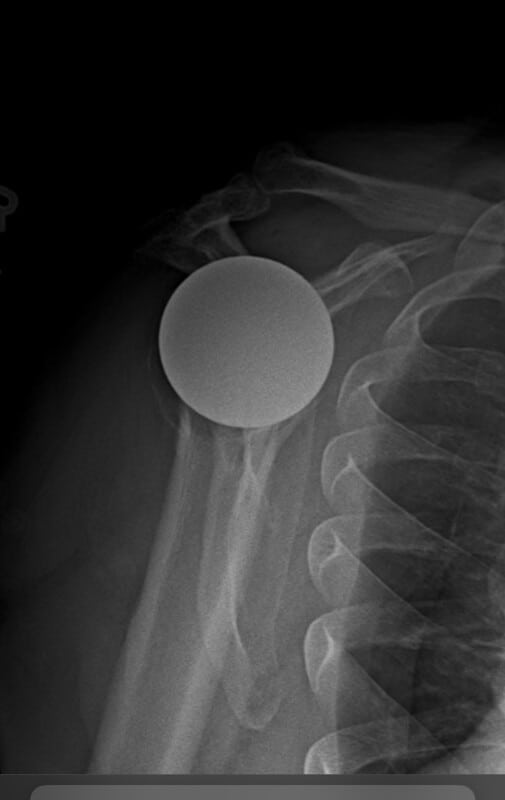 Shoulder Innovations - Stemless - Anatomic<br><span>Click image to see a larger version.</span>