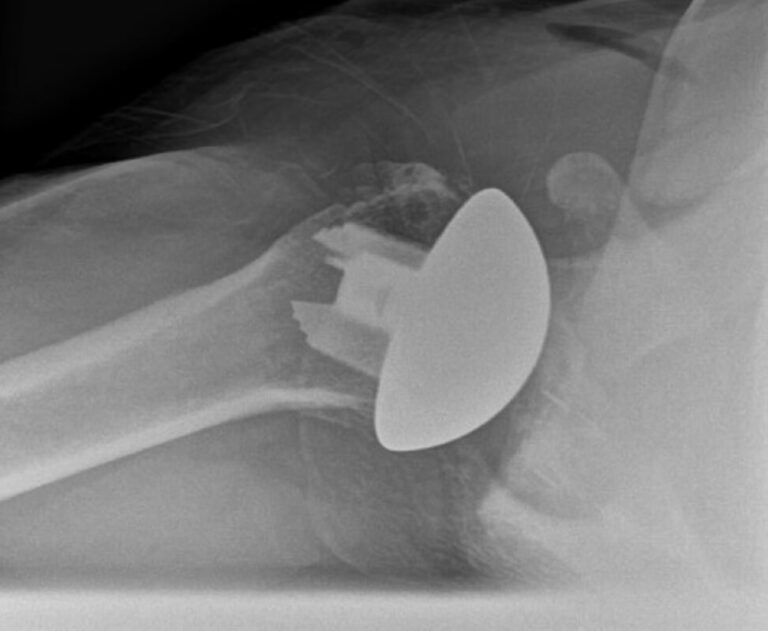 DJO/Enovis - Stemless - Anatomic<br><span>Click image to see a larger version.</span>