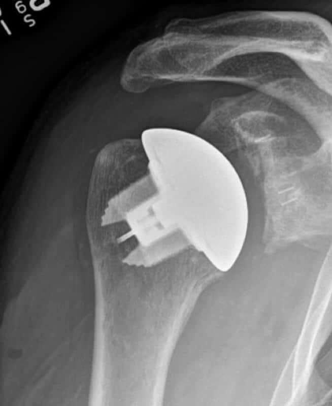 DJO/Enovis - Stemless - Anatomic<br><span>Click image to see a larger version.</span>