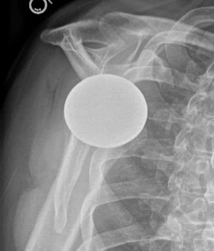 DJO/Enovis - Stemless - Anatomic<br><span>Click image to see a larger version.</span>