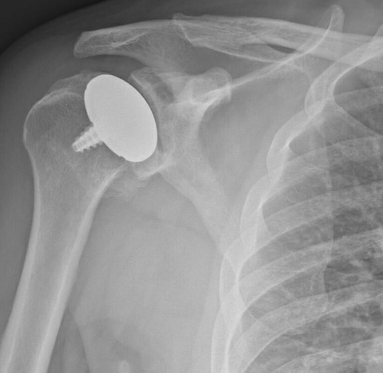 Arthrosurface - Resurfacing - Anatomic<br><span>Click image to see a larger version.</span>