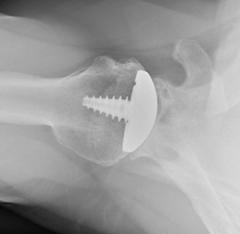 Arthrosurface - Resurfacing - Anatomic<br><span>Click image to see a larger version.</span>