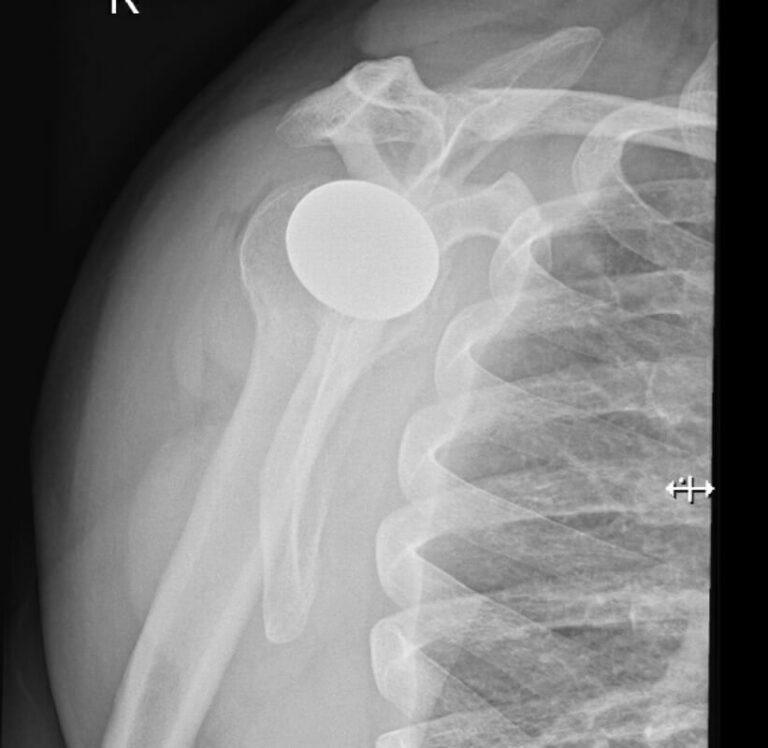 Arthrosurface - Resurfacing - Anatomic<br><span>Click image to see a larger version.</span>
