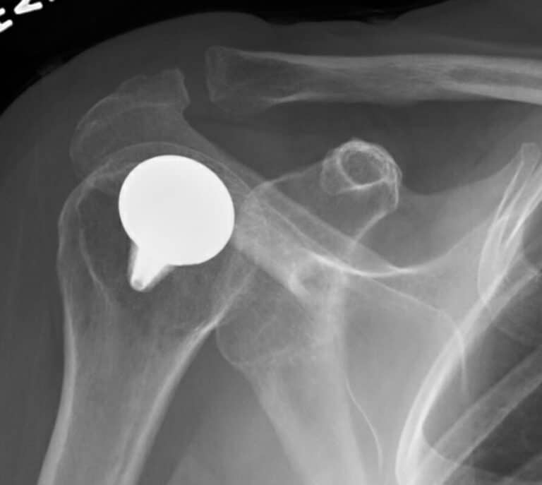 Arthrosurface - Resurfacing - Anatomic<br><span>Click image to see a larger version.</span>