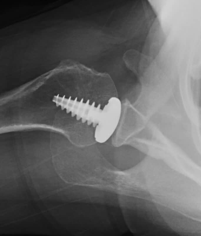 Arthrosurface - Resurfacing - Anatomic<br><span>Click image to see a larger version.</span>