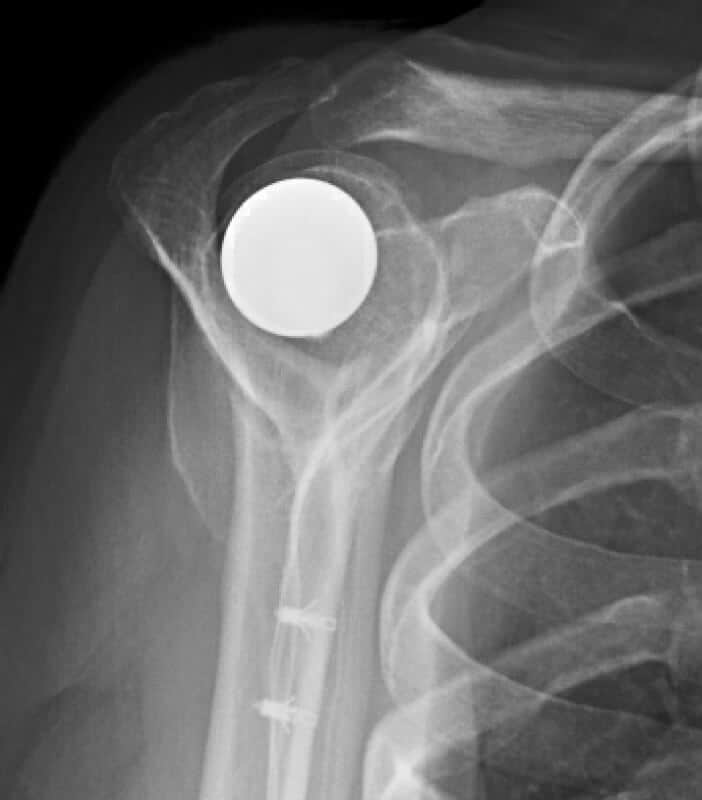 Arthrosurface - Resurfacing - Anatomic<br><span>Click image to see a larger version.</span>