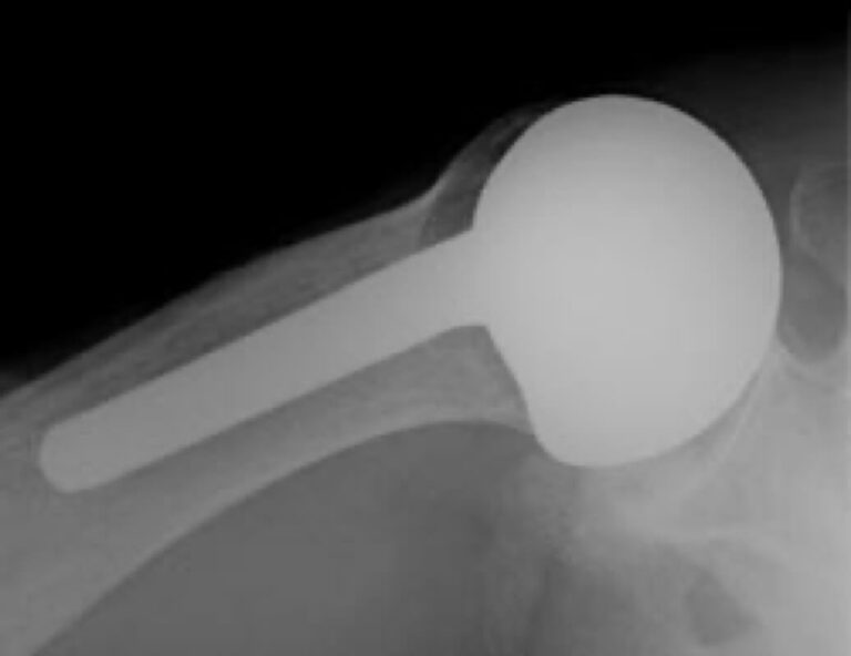 DePuy - Standard - Anatomic<br><span>Click image to see a larger version.</span>