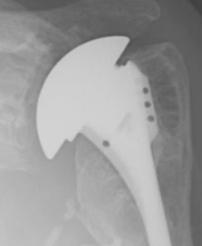 DePuy - Standard - Anatomic<br><span>Click image to see a larger version.</span>