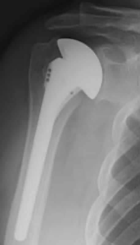 DePuy - Standard - Anatomic<br><span>Click image to see a larger version.</span>