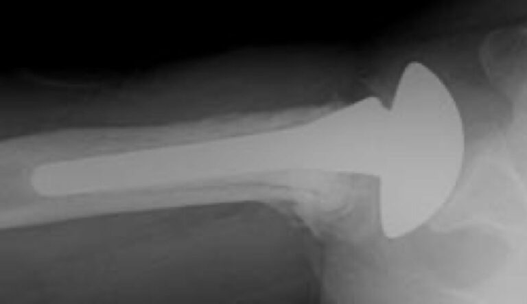 DePuy - Standard - Anatomic<br><span>Click image to see a larger version.</span>